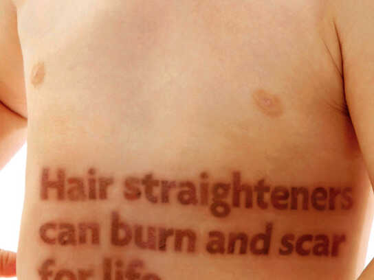 Hair Straighteners burn