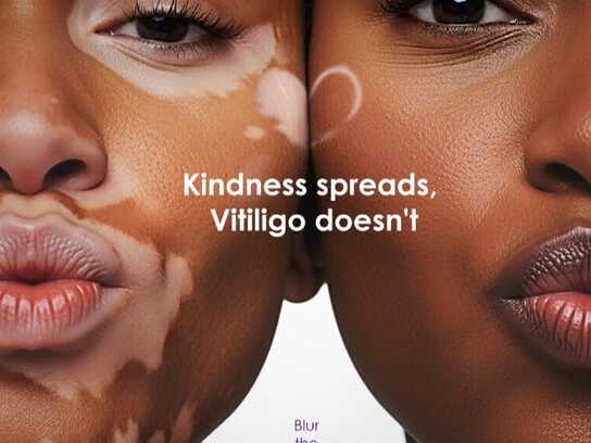 Kindness Spreads, Vitiligo doesn't 