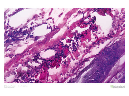 The Art Campaign of the Cancer Society of North Rhine-Wes...